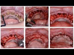 For more information please visit physicsforceps.com or call. Achieving Atraumatic Extractions Socket Preservation Continuing Education Physics Forceps Youtube