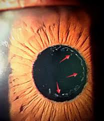 Elements strategy initiative center for magnetic materials(esicmm). Scientists Find Gene Mutation Linked To Exfoliation Syndrome Most Common Cause Of Glaucoma Eurekalert Science News