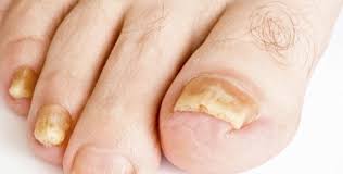 Tendemos a pensar que los hongos suelen aparecer sobre todo en los dedos de los si tienes las uñas amarillentas, verdes o marrones, no dudes en echar un vistazo a estos remedios. Sufres De Unas Con Hongos Conoce Aqui Como Curarlas
