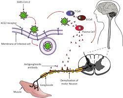 Most patients present with an antecedent illness, most commonly upper respiratory tract infection, before the onset of progressive motor weakness. Covid 19 Associated Guillain Barre Syndrome Atypical Para Infectious Profile Symptom Overlap And Increased Risk Of Severe Neurological Complications Springerlink
