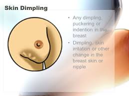 Dimpling does not necessarily mean cancer, she says. Breast Cancer Prevention Early Detection Ppt Video Online Download