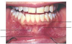 Image result for Labial mucosa
