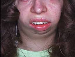 Image result for Micrognathia