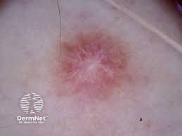 Image result for Dermoscopy