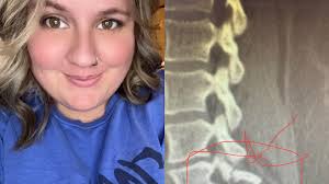 Fundraiser by Kayla Lytle : Support Urgent Surgery for Spinal Health