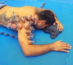 Rebound therapy learn about how trampoline based exercises can be used in treatment powered by physiopedia start course presented by: 47 Cupping Benefits Ideas Cupping Therapy Cupping Massage Hijama