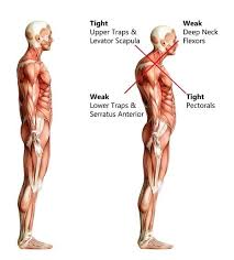 Scm is the largest muscle of the neck. Upper Crossed Syndrome