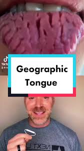 Image result for Fissured tongue