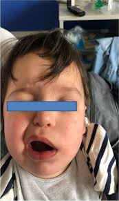 Acute otitis media-related facial nerve palsy in a child: a case report and  a literary review