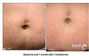 Laser treatment is widely considered the most effective stretch mark removal option. Stretch Mark Removal Laser Treatments Nyc Nj Schweiger