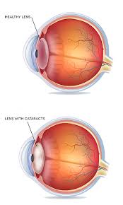 Image result for Cataract Extraction