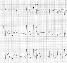 Nas fases mais iniciais do enfarte, o ecg poderá ser normal ou aproximadamente normal e cerca de 10% dos doentes com enfarte comprovado os sinais mais precoces de enfarte do miocárdio são bastante subtis, sendo um deles a elevação da amplitude da onda t, sendo esta onda t. Http Www Siacardio Com Wp Content Uploads 2015 01 Atrial Infarction Inferior Myocardial Infarction Atrial Arrhythmia A Forgotten Triad Pdf