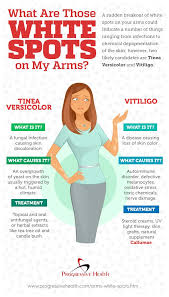 I Have White Spots On My Arms What Are They Vitiligo Skin Spots Vitiligo Treatment