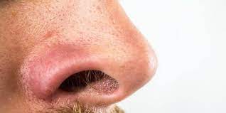 16% sekitar kawasan antara rahang bawah hingga dagu. 6 Cara Menghilangkan Komedo Hitam Di Hidung Secara Alami Ketahui Penyebabnya Merdeka Com