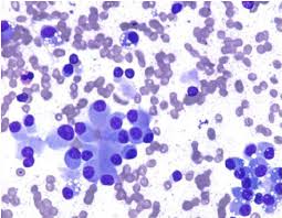 Carcinoid Giemsa Kleuring Medical Laboratory Microscopic Cells Oncology