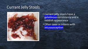 Image result for dark black stool human poop