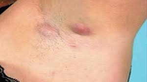 Koltuk Altlari Ve Kasik Cevresinde Gorulen Hidradenitis Suppurativa Yasam Kalitesini Bozuyor