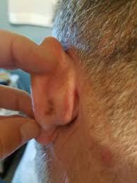 Majority of the ear cancers are squamous cell carcinomas. Skin Cancer Melanoma On Ear Graphic Warning Multi Post Jamboards