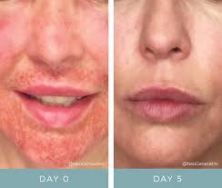 Laser Treatments Skin Care Products Pre and Post Laser