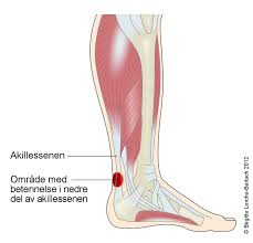 Det er store smerter og såret hovner opp når jeg spiller. Tibialis Posterior Tendinopati Nhi No