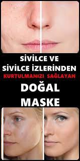 Sivilce Ve Sivilce Izleri Icin Dogal Maskeler Movie Posters Movies