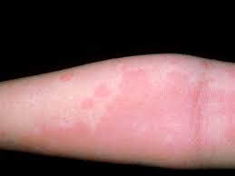 We did not find results for: What 10 Common Skin Rashes Look Like