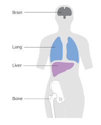 Metastatic Breast Cancer Wikipedia
