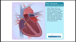 Paroxysmal supraventricular tachycardia (psvt) a narrow qrs tachycardia that begins and ends abruptly; Psvt Paroxysmal Supraventricular Tachycardia Animation Video Youtube