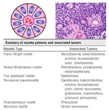 Retinoblastoma is an embryonal tumour and is the most common malignant tumour of the eye. Flexner Wintersteiner Rosette Humpath Com Human Pathology