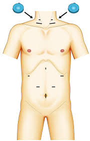 Mckeown esophagectomy is a surgical procedure to remove the esophagus and the upper portion of the stomach. Mediastinoscopic Esophagectomy With Lymph Node Dissection Using A Bilateral Transcervical And Transhiatal Pneumomediastinal Approach