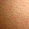 Ipl is intense pulsed light, wrinkle laser, ipl beauty, skin rejuvenation, acne treatment, home ipl,at home ipl photofacial, at home. 1