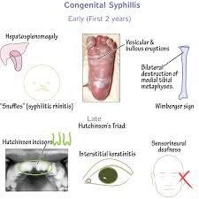 Image result for Syphilis