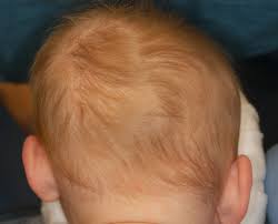  plagiocephaly