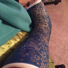 Image Result For How To Decorate Plaster Cast Leg Cast Decoration Arm Cast Leg Cast