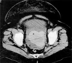 Possible causes, signs and symptoms, standard treatment options and means of care and support. Radiology In The Diagnosis Staging And Management Of Gynecologic Malignancies Glowm