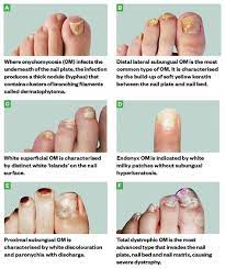 how to treat fungal nail effectively learning article pharmaceutical jou nail fungus treatment best toenail fungus treatment toenail fungus laser treatment
