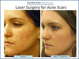 Pin On Acne Scars
