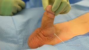 Image result for Penile Prosthesis
