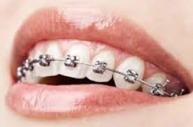 Corega pulizia apparecchi ortodontici 30 compresse. Apparecchi Ortodontici E Igiene Orale Philips Sonicare