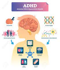 Auch bei erwachsenen stellt die behandlung mit methylphenidat nach deutschen leitlinien eine therapeutische option dar. Adhd Vector Illustration Labeled Attention Deficit Hyperactivity Royalty Free Cliparts Vectors And Stock Illustration Image 123463608