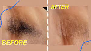 Take note that the armpit hair should be 5 millimeters to 10 millimeters before getting it waxed. Waxing Underarms Using Diy Sugar Wax Abetweene Youtube