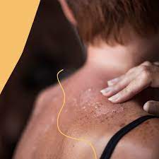 How To Stop Sunburn Peeling Skin: A Skin Expert's Best Advice For Burns |  Glamour Uk