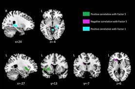 .of the deep cerebellar nuclei in the monkey, with observations on the. Bookbrain Stem Nuclei Helpful Brainstem Figures Litfl Neurology Rule Of 4 Brainstem Development Is Similar To Spinal Cord Development And Unfolds Like A Book
