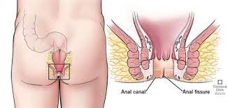 Tubegalore.com has a huge collection of porno :: Anal Fissures Causes Symptoms Treatment Prevention