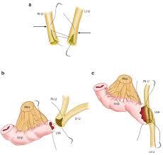 Image result for Urelytrum