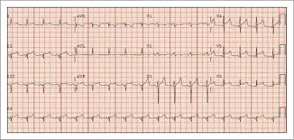 Image result for Post-MI Pericarditis