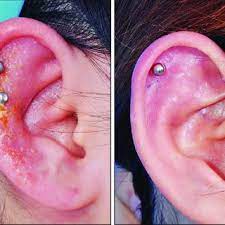 Pdf Common Complications After Auricular Piercing In Korea Case Reviews And Treatment