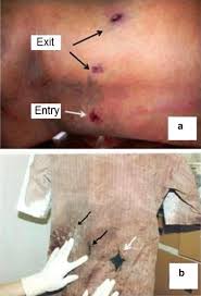 Bullet wound over right parietal bone, 4 inches long, crosses lower end of rolando. Multiple Suicidal Firearm Injuries A Case Study Sciencedirect