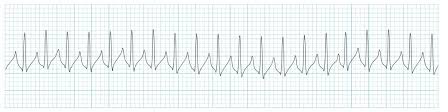 There are four main types: Supraventricular Tachycardia Cardiovascular Medbullets Step 2 3