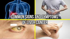 A faint rattle or gurgling sound may be heard as the patient tries to breathe in and out. Common Signs And Symptoms Of Liver Cancer Youtube